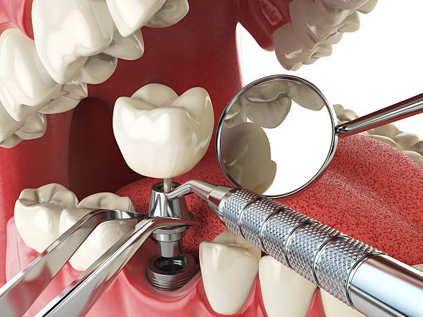 Best Emergency Dentist for Lost Fillings or Crowns in Northville, MI