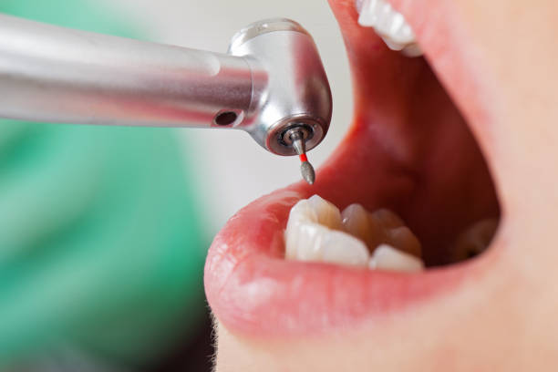 Best Emergency Dental Care for Abscessed Tooth in Northville, MI